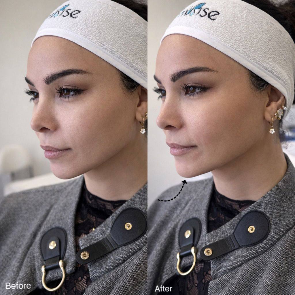 The Art of Beautification with Filler