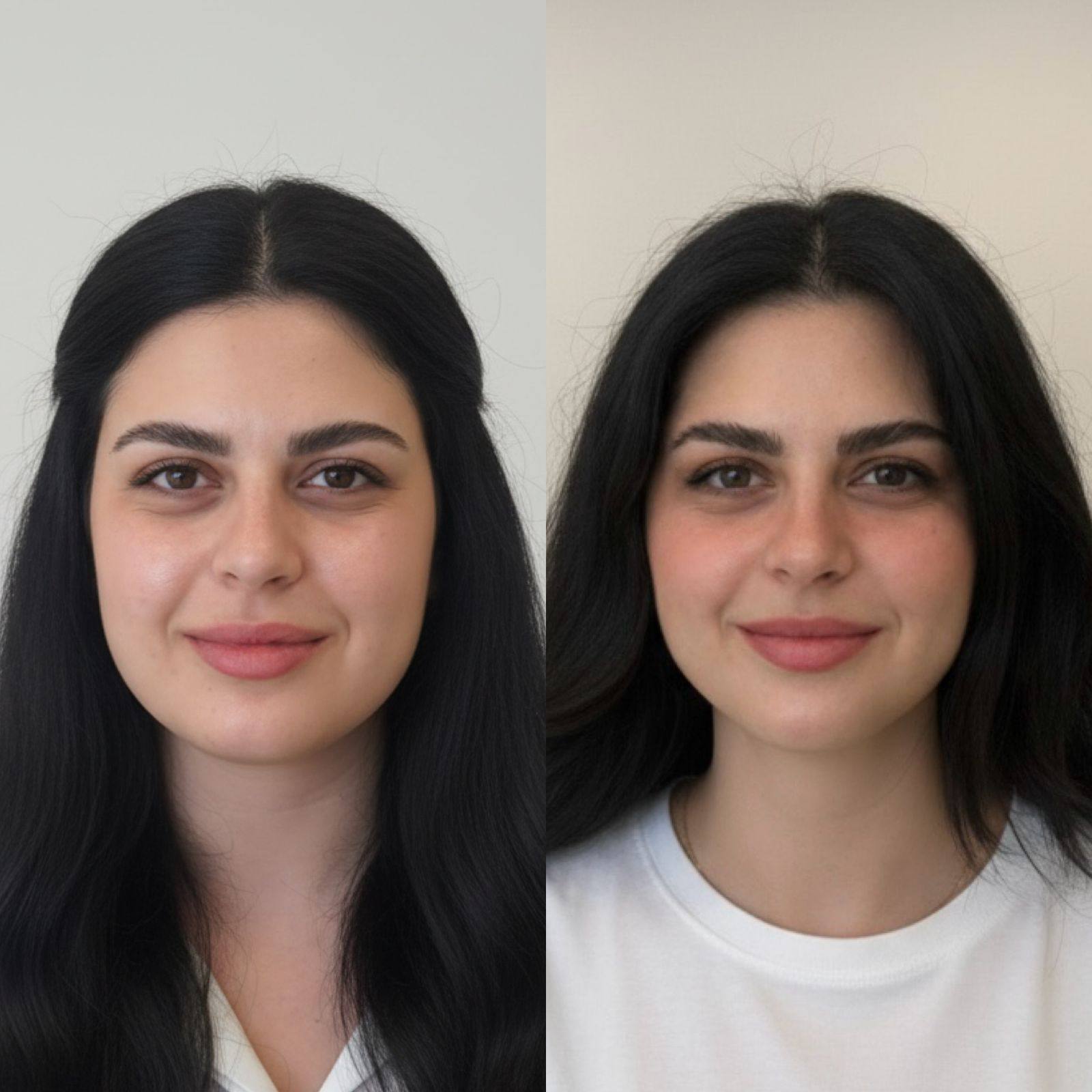 The Art of Facial Slimming & Definition with Filler