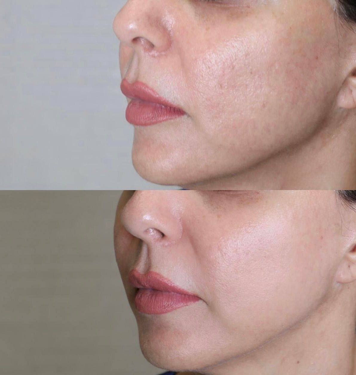 The Art of Fractional CO2 Laser for Acne Scar Renewal