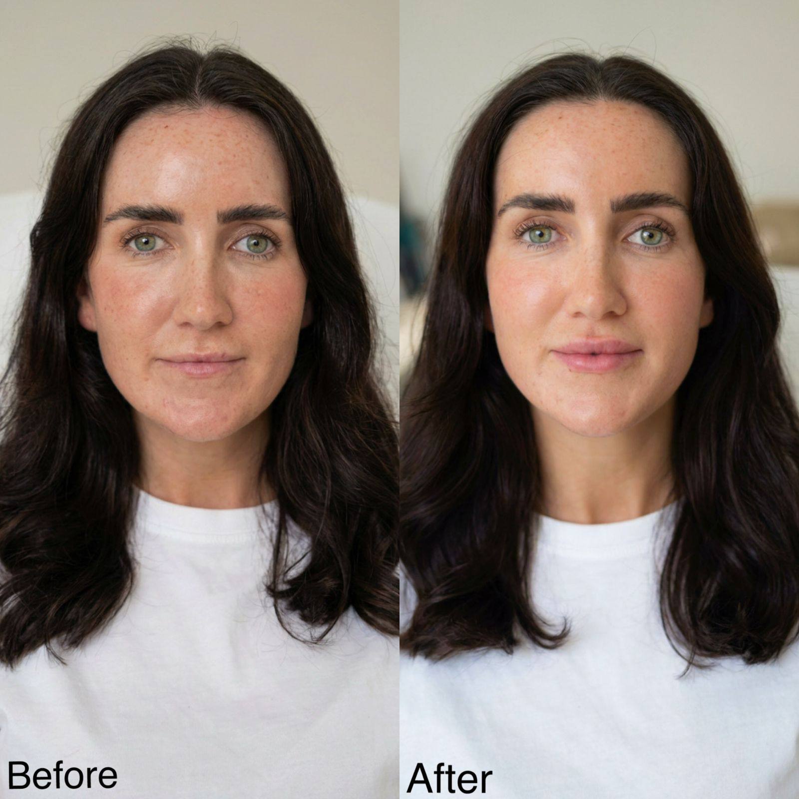 The Art of Lift-glow with Skin Boosters