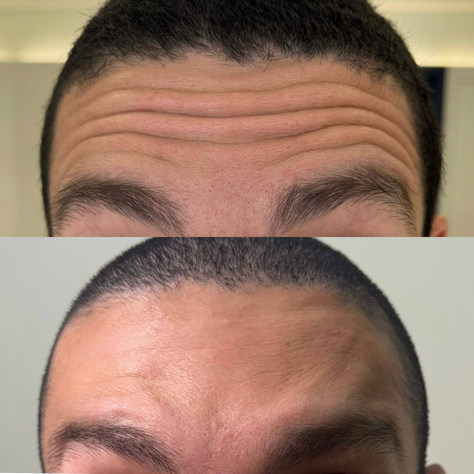 The Art of Botox