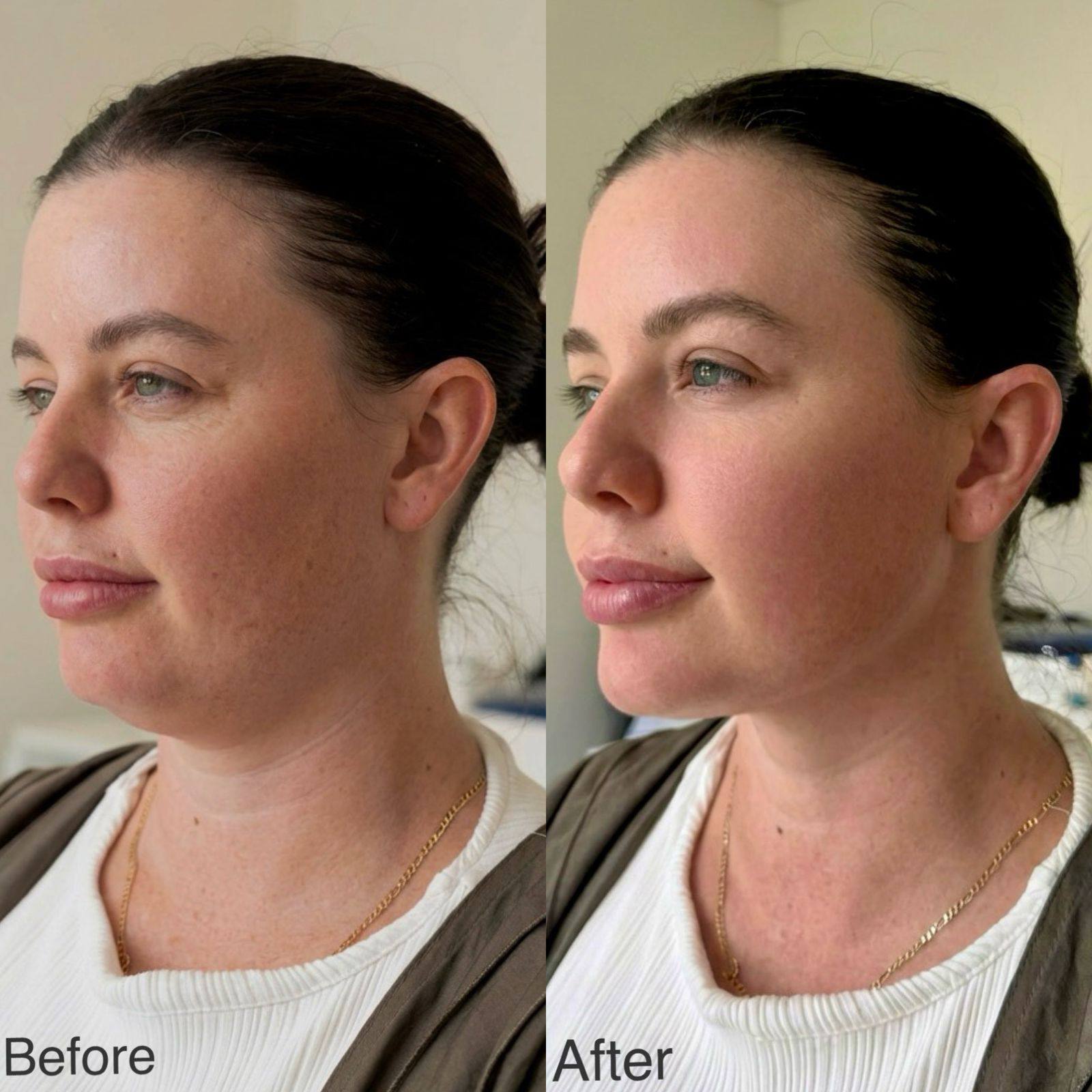 The Art of Combining Ultrasound & Filler
