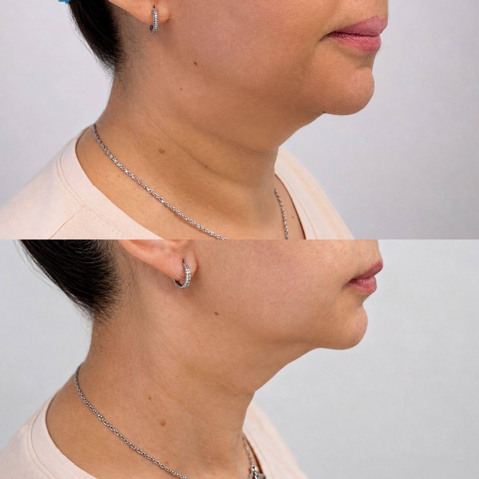 The Art of Skin Tightening with Ultraformer